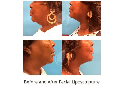 Facial Liposculpture before and after