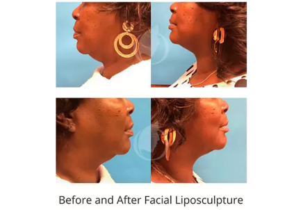 Facial Liposculpture before and after