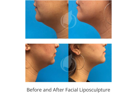 Facial Liposculpture before and after