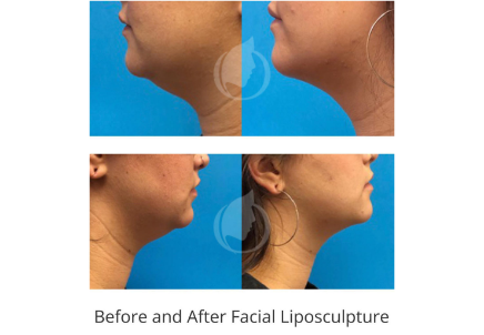 Facial Liposculpture before and after