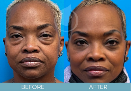 Eyelid Surgery before and after