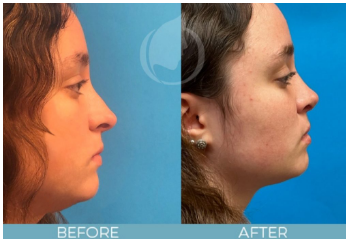 Rhinoplasty before and after Rhinoplasty before and after
