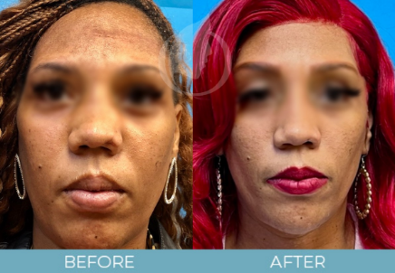 Rhinoplasty before and after Rhinoplasty before and after