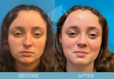 Rhinoplasty before and after Rhinoplasty before and after