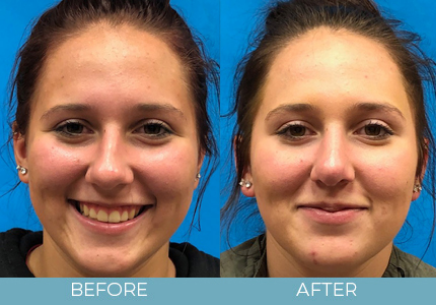 Rhinoplasty before and after