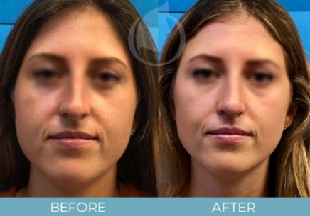 Rhinoplasty before and after