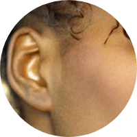 otoplasty ear pinning
